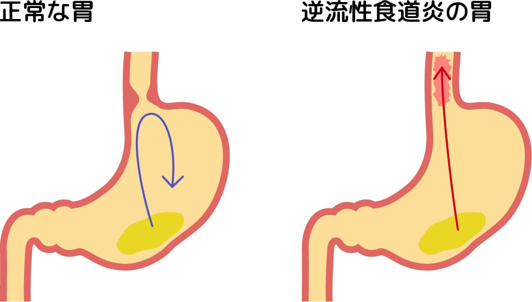 正常な胃と逆流性食道炎の胃