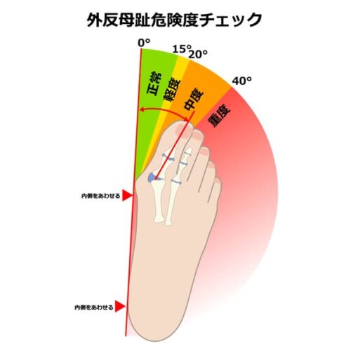 外反母趾の基準