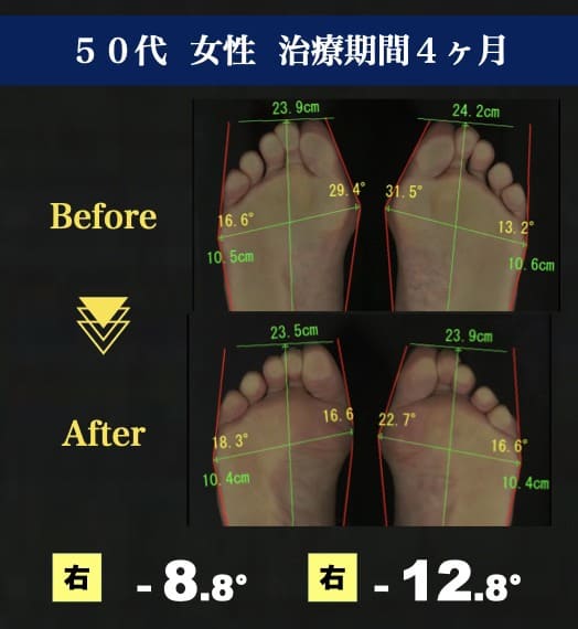 50代女性　外反母趾