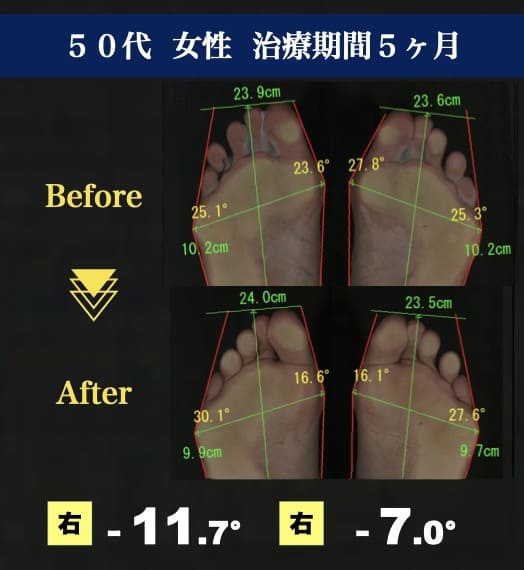 50代女性　外反母趾