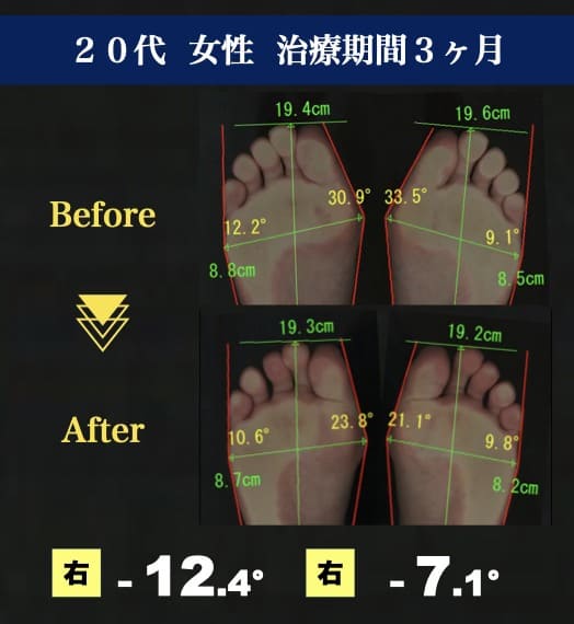 20代女性　外反母趾