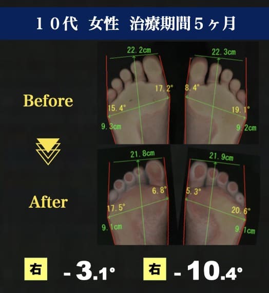 10代女性　外反母趾