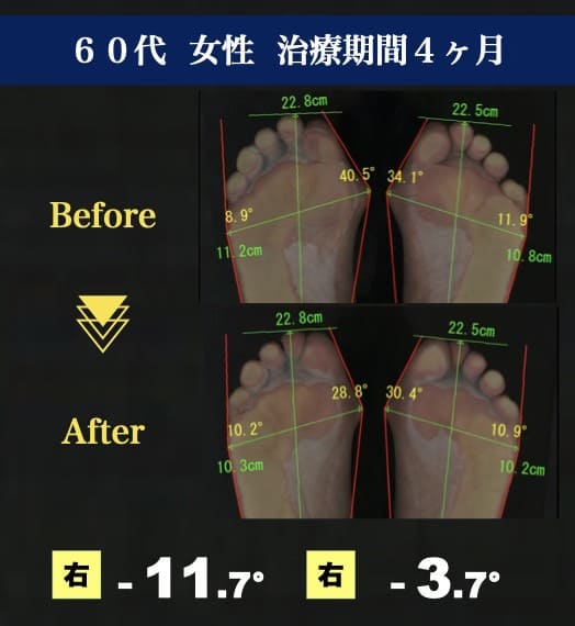 60代女性　外反母趾